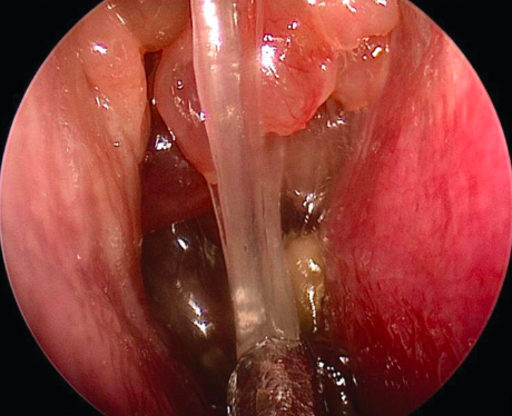 Allergic Fungal Rhinosinusitis