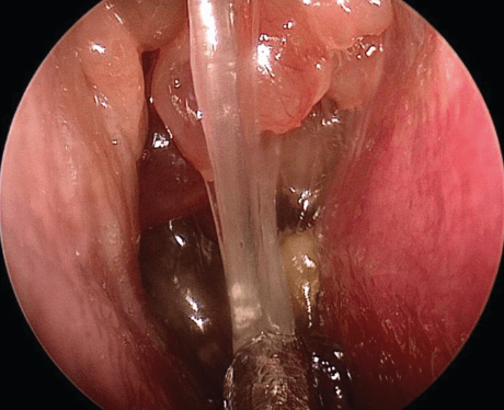 Allergic Fungal Rhinosinusitis