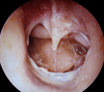 Ear drum perforation? How to treat surgically&nbsp;:)