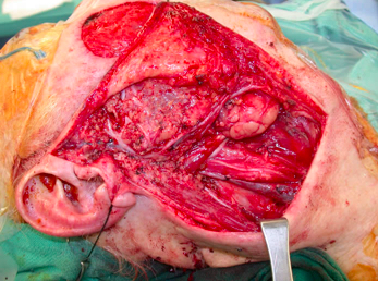 Outpatient parotidectomy ??!!