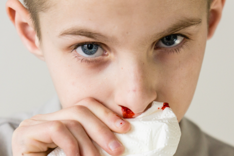 Stop the Bleed: 7 Essential Tips for Preventing and Treating Nosebleeds