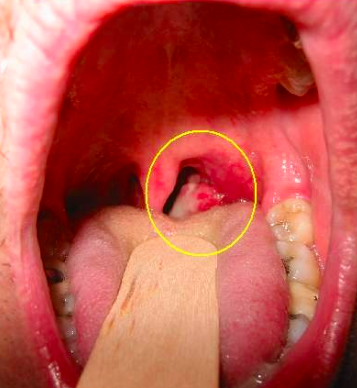 Liquid biopsy for HPV-associated oropharyngeal cancer?