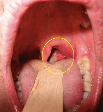 Liquid biopsy for HPV-associated oropharyngeal&nbsp;cancer?