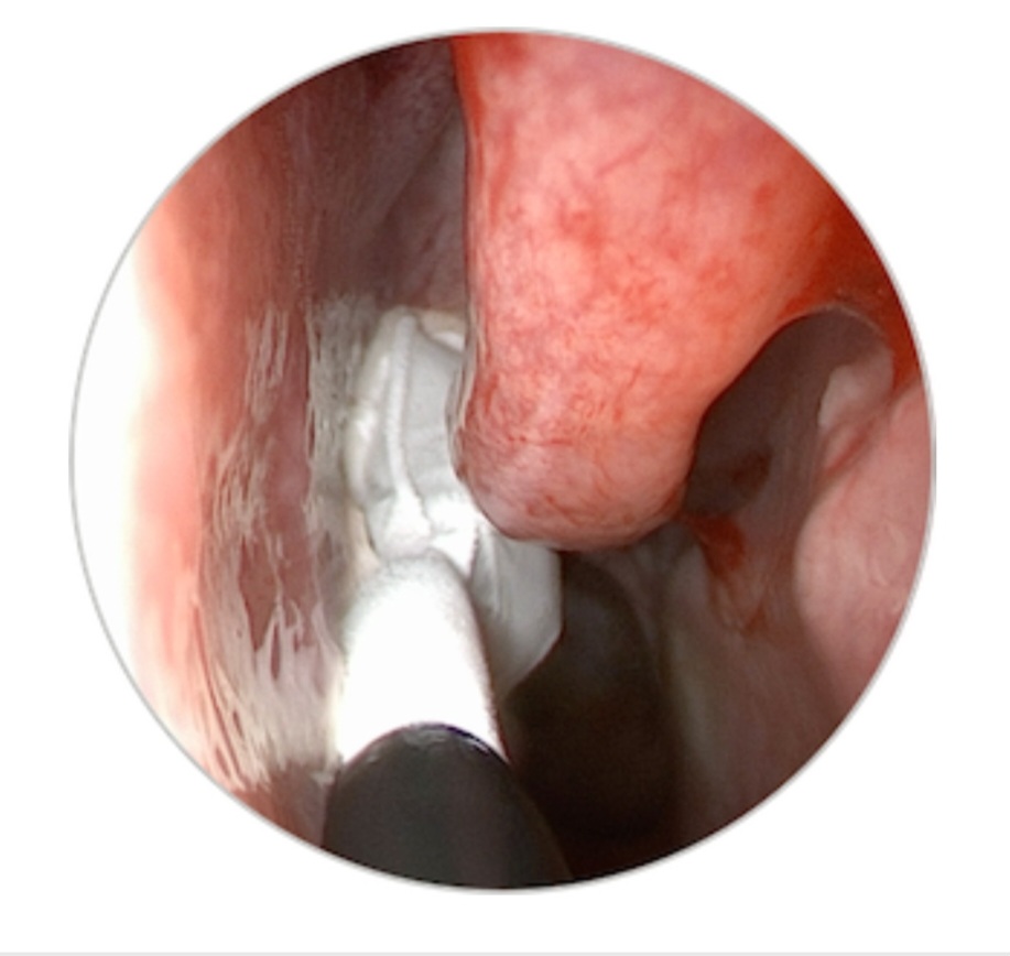 Cryotherapy in Chronic Rhinitis: A Promising Therapeutic Approach