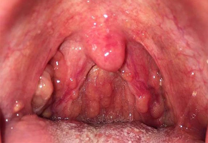 Ultimate Guide to Relieving Pharyngitis Discomfort: Expert Tips for Conquering&nbsp;Symptoms