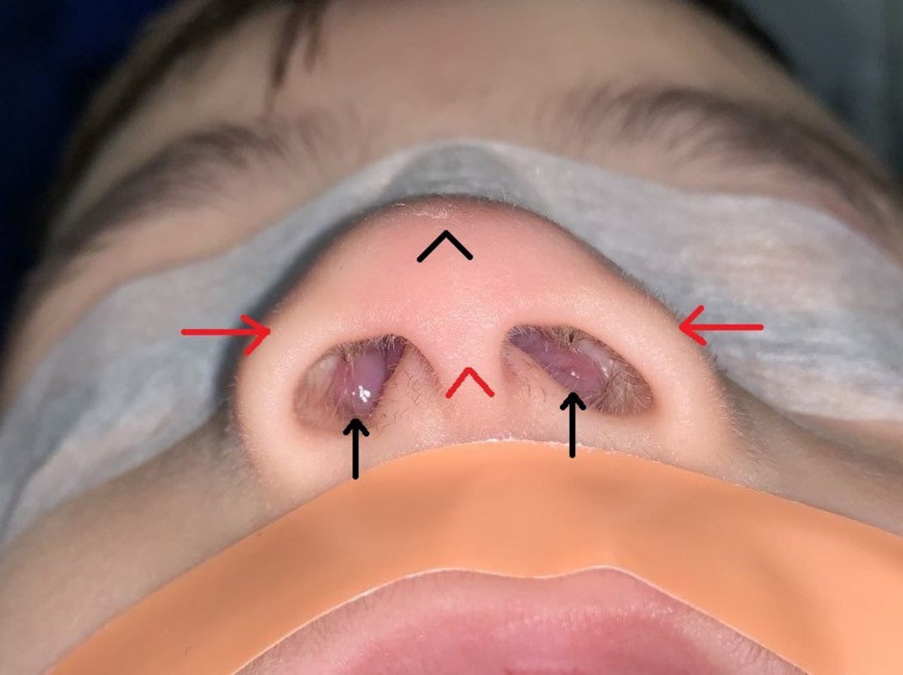 Unveiling Effective Surgical Treatments for Chronic Nasal Blockage in Children