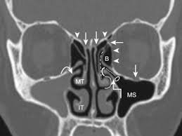 Preoperative Evaluation of Paranasal Sinus Computed Tomography