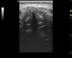 Ultrasound Screening After Cardiac Surgery Shows Vocal Fold Impairment and Predicts Aspiration