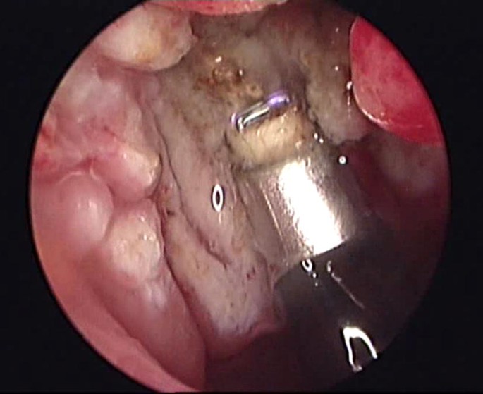 Coblator adenoidectomy in pediatric patients: a state-of-the-art review