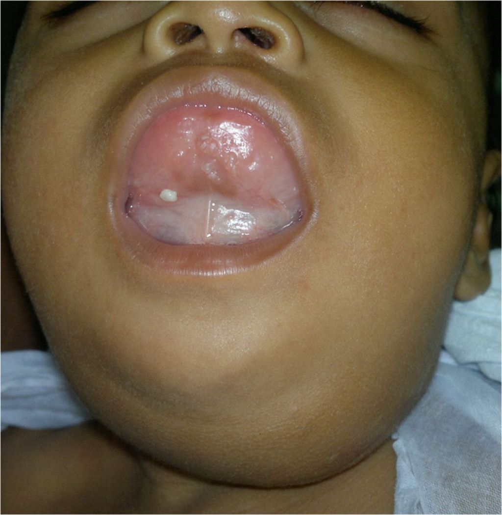 Exploring the Depths of Medical Marvels: Ludwig’s Angina&nbsp;Unveiled