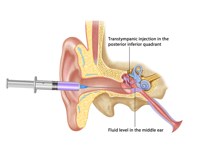 Enhancing Hearing: Intratympanic Steroid Injections for Sudden Sensorineural Hearing Loss&nbsp;(SSNHL)