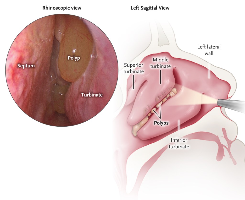 Analysis of structured histopathology in prognosticating surgical outcomes of nasal&nbsp;polyps