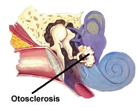 Stapes Surgery: A Vital Advancement in Restoring Hearing Health