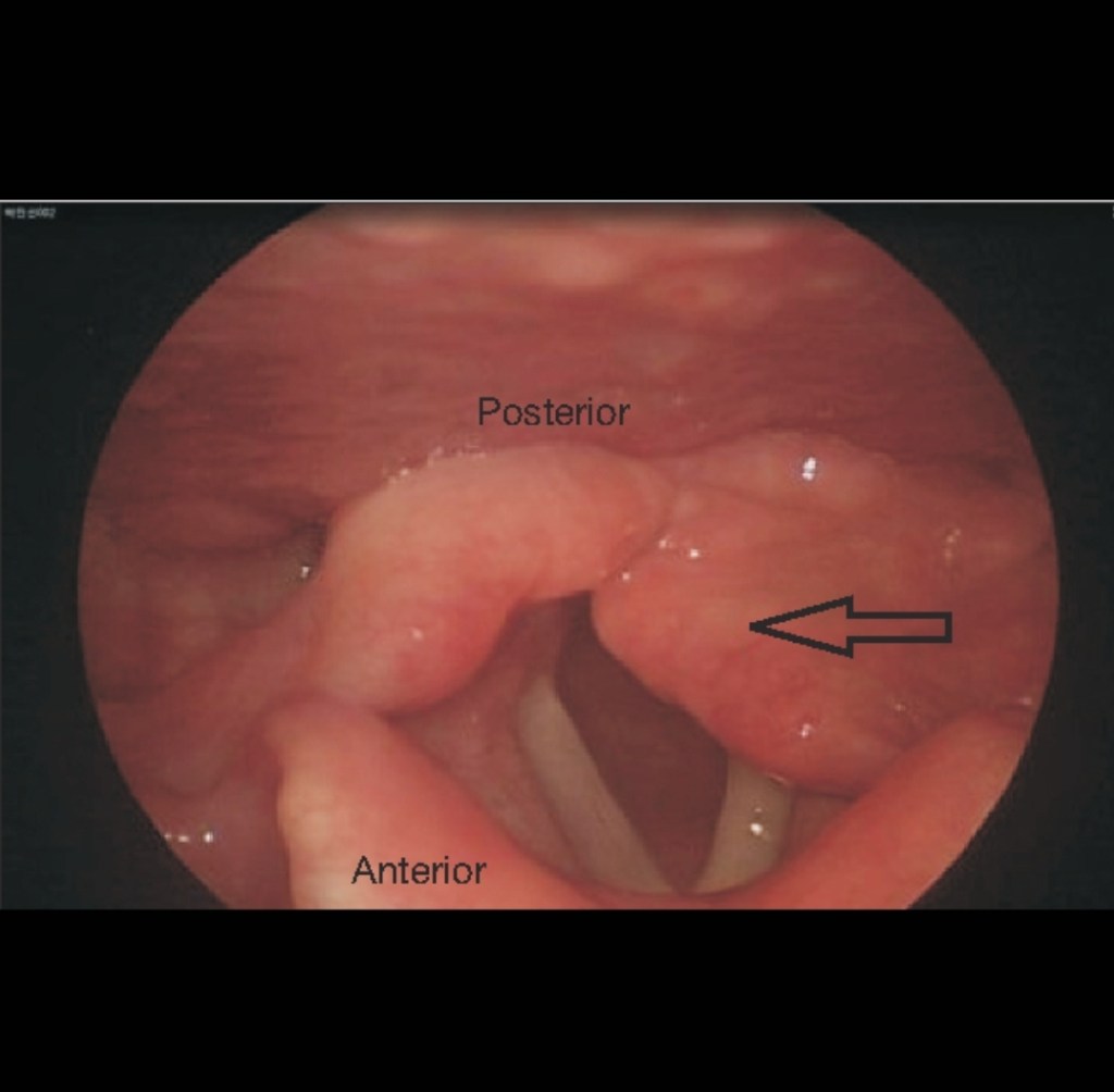 Arytenoid reduction in paediatric&nbsp;patient?