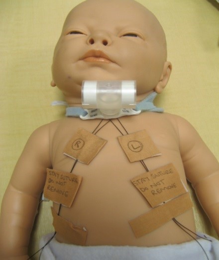 Perioperative and Long-Term Outcomes in Infants Undergoing a Tracheostomy from a Neonatal Intensive Care&nbsp;Unit