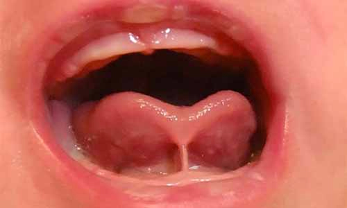 Complications after tongue-tie&nbsp;release