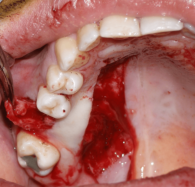 Oroantral Fistula Closure Using Double-Layered Flap: Greater Palatine Artery Flap and Buccal Fat Pad