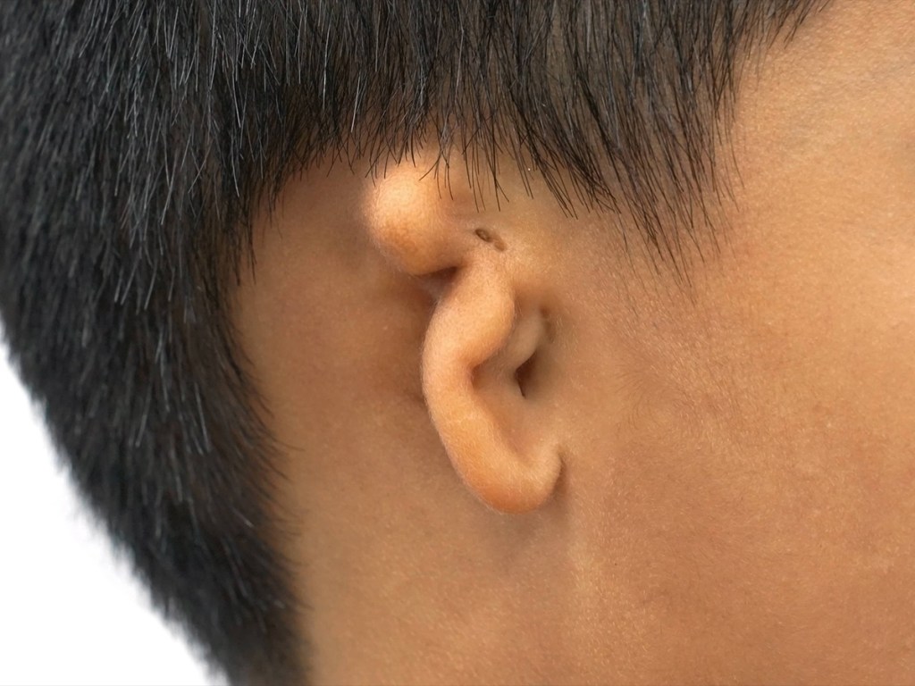 Microtia Reconstruction – Nagata&nbsp;Technique