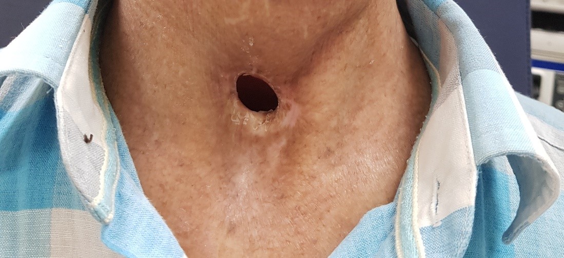 Echoes of Choice: Patient Reflections Post-Surgery for Laryngeal Cancer