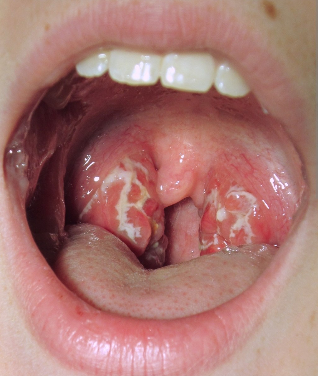 Chronic Tonsillitis: Insights and the Benefits of&nbsp;Tonsillectomy
