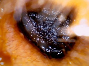 Unveiling Impacted Ear Wax: Causes, Complications, and Prevention Strategies