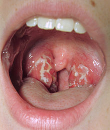 Tonsillitis: Doktor, bila kena buang tonsil (tonsillectomy/ operasi&nbsp;amandel)?