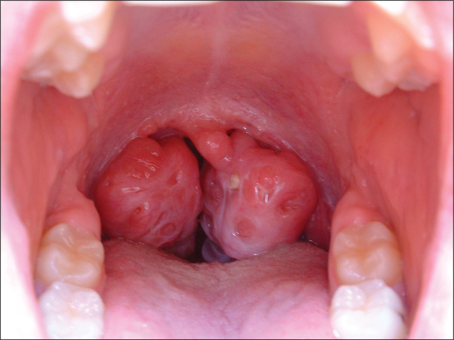 Menyingkap Misteri Pembesaran Tonsil