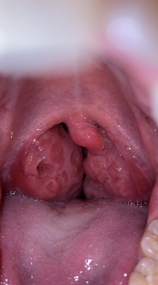 Unraveling the Mysteries Behind Enlarged&nbsp;Tonsils