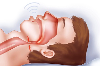 Understanding Sleep Apnea: A Hidden Risk to Your&nbsp;Health