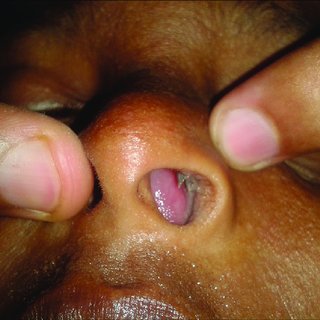 Deviated Nasal Septum: Understanding Causes, Symptoms, Signs, and Surgical Treatment&nbsp;Options