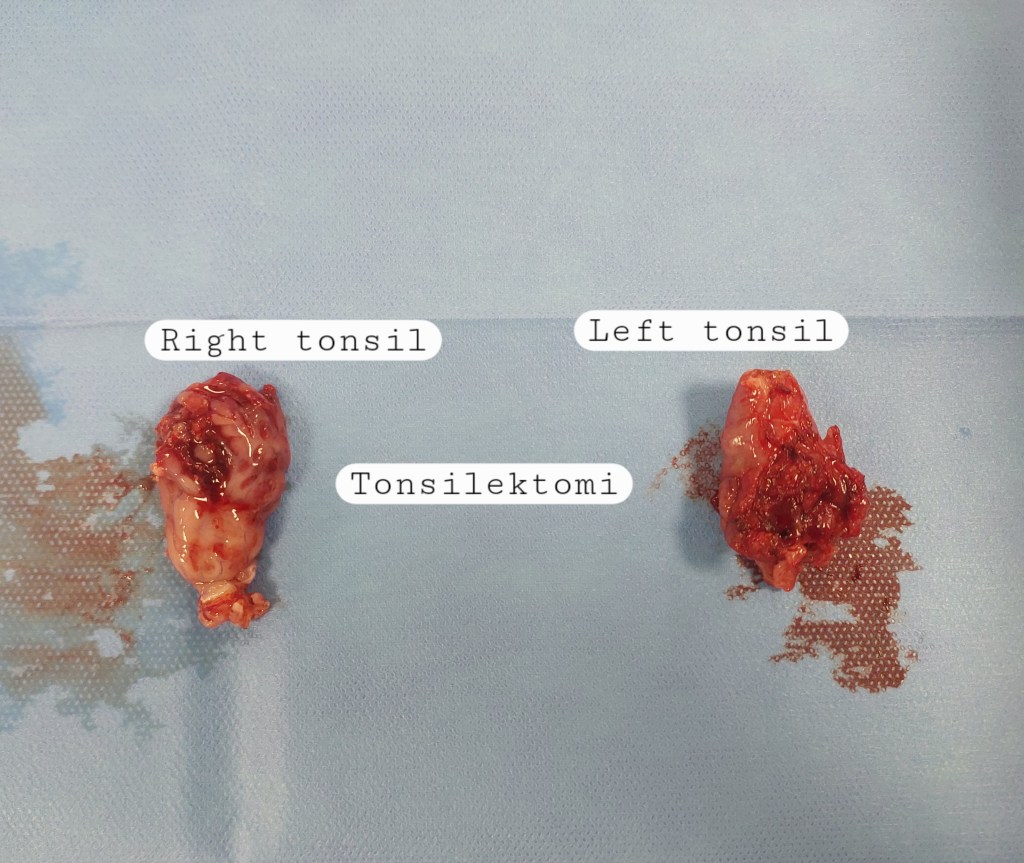 Bila Perlu Melakukan&nbsp;Tonsilektomi?