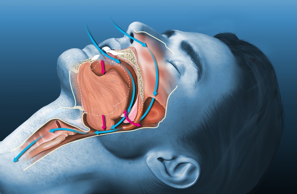 Panduan Rawatan Masalah Dengkur/Sleep Apnea/Microsleep/OSA di Hospital Swasta.