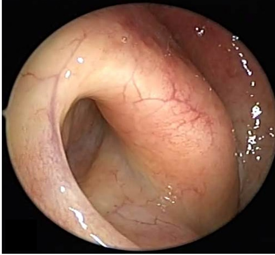 Patulous Eustachian Tube – When Your Ear Feels Too “Open”