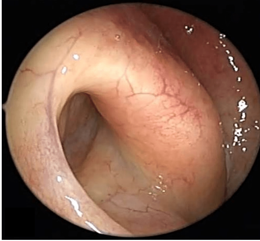 Patulous Eustachian Tube – When Your Ear Feels Too&nbsp;“Open”