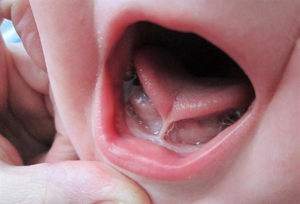 Lidah Pendek (Tongue Tie/Ankyloglossia): Kenali Simptom, Risiko & Rawatan Mudah untuk Senyuman Sihat!&nbsp;👶🗣️