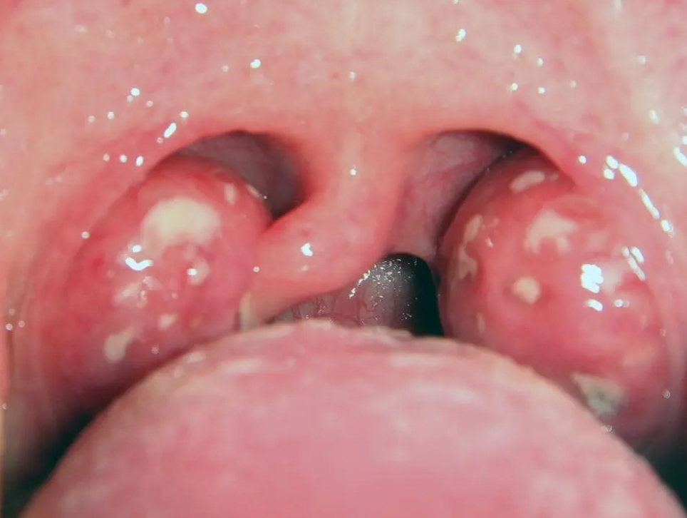 TONSIL/AMANDEL BENGKAK: Bahaya Tersembunyi di Kerongkong&nbsp;Anda!