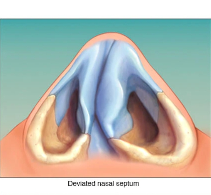 Sempit Nafas Akibat Tulang Hidung Bengkok? Kenali Deviated Nasal&nbsp;Septum!