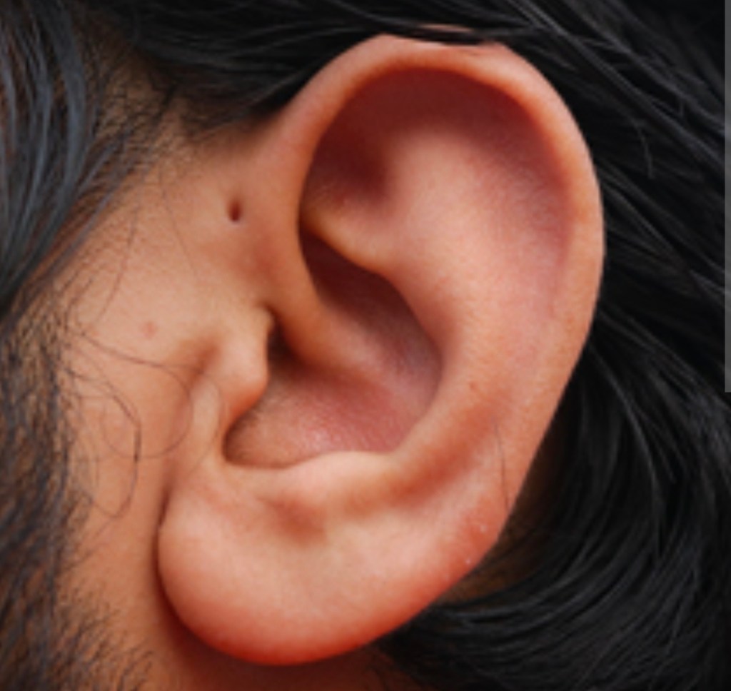 The Tiny Pit in Front of Your Ear: Is Pre-auricular Sinus&nbsp;Dangerous?