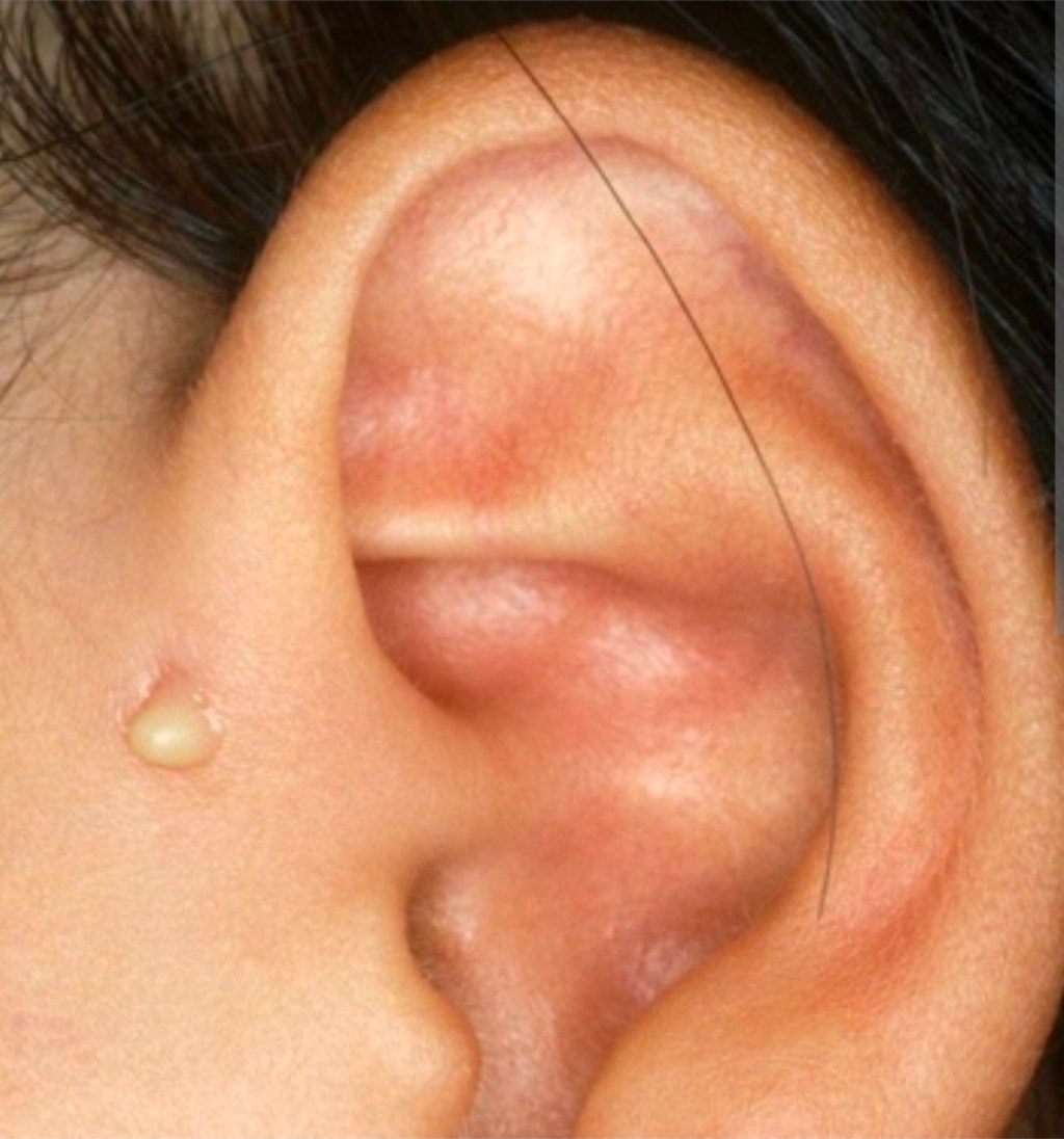 Bintik Kecil Depan Telinga Anda: Sinus Pra-Auricular Adakah Ia&nbsp;Berbahaya?
