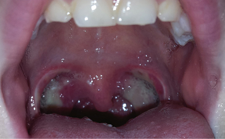Comprehensive Guide to Post-Tonsillectomy Care for Adults and Paediatric Patients