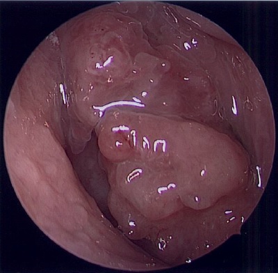 Nasopharyngeal Carcinoma: A Comprehensive 7-Part Series (Part 1)