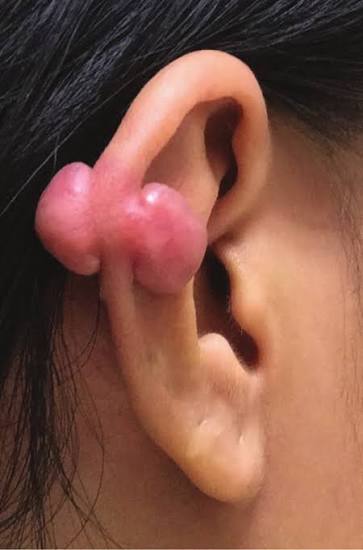 👂 Understanding and Managing Pinna Keloids: A Guide to Causes and Advanced&nbsp;Treatment