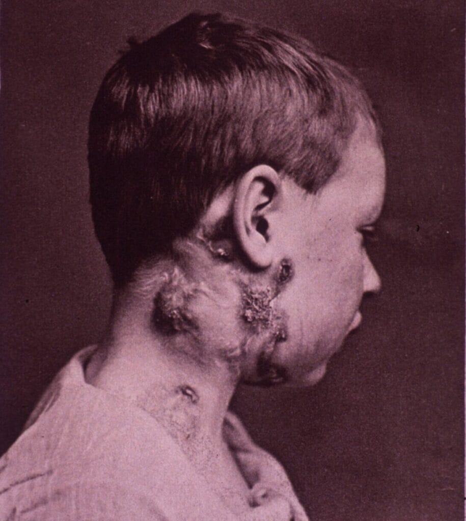The Hidden Dangers of TB Lymphadenitis: Evidence-Based Clinical Risks
