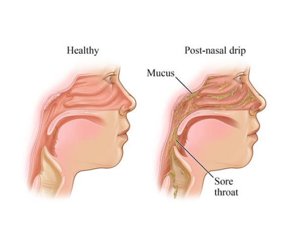 The Phantom Tickle: Silencing the Chronic Dry Cough of&nbsp;Rhinosinusitis