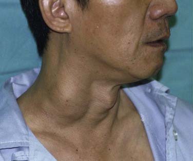 Profile view of a man showing a visible swelling on the neck.