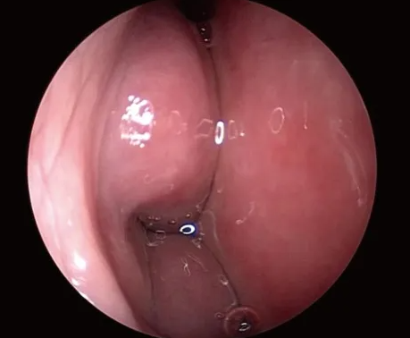 Close-up view of a medical endoscopic procedure showing the interior of a throat or esophagus, with visible mucosal surface and fluid.