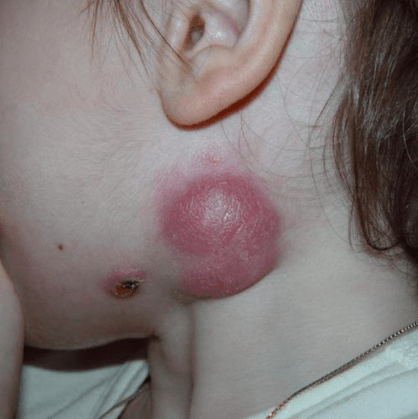 Close-up of a child's neck showing a raised, red skin lesion with a scabbed area, indicating possible infection or irritation.