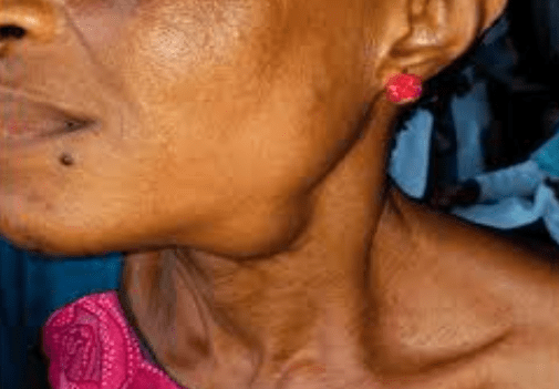 Close-up of a woman's neck and ear, showing a small mole and a pink earring, with a blurred background.