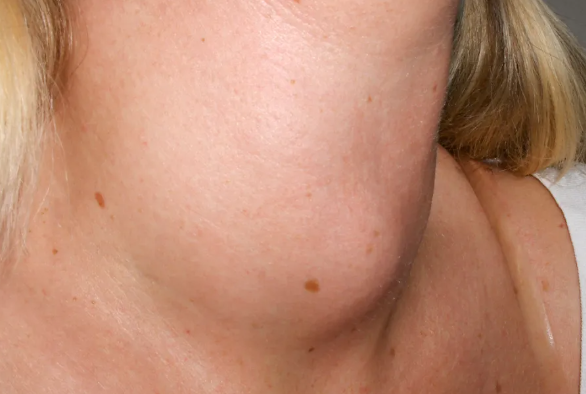 Neck Swelling Explained by an ENT Specialist in Kuala Lumpur – Part 4