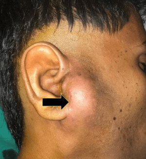 Close-up of a man's ear showing a noticeable swelling behind the ear, with an arrow indicating the area of concern.